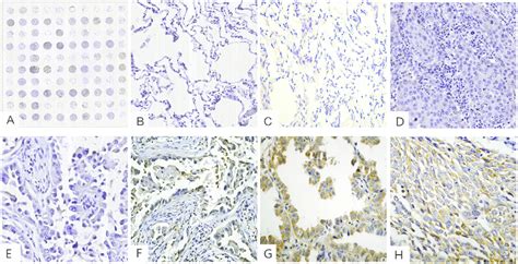 Ihc Analysis Of Stathmin In Lung Cancer And Normal Lung Tissues