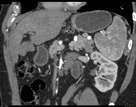 Unusual Neuroendocrine Tumor Of The Tail Of The Pancreas With Liver