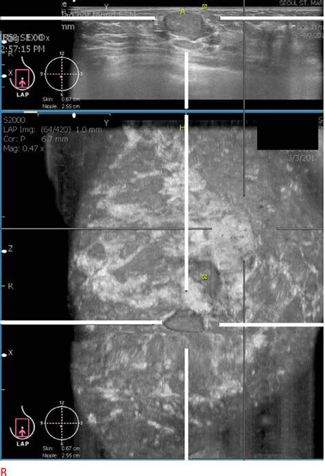 Figure 6 From Image Quality And Artifacts In Automated Breast