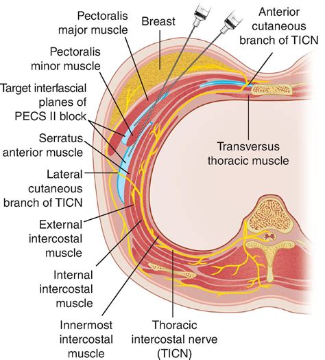 Myofascial Injections And Fascial Plane Blocks For Perioperative And