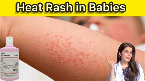 Garmi Dano Ka Ilaj Prickly Heat Treatment At Home Heat Rash