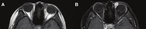 Case 1 Pre Contrast T1 Weighted Axial Mr Image Demonstrating A Left