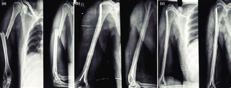 Pre Op Post Op And Follow Up Radiographic Images Anterior Posterior