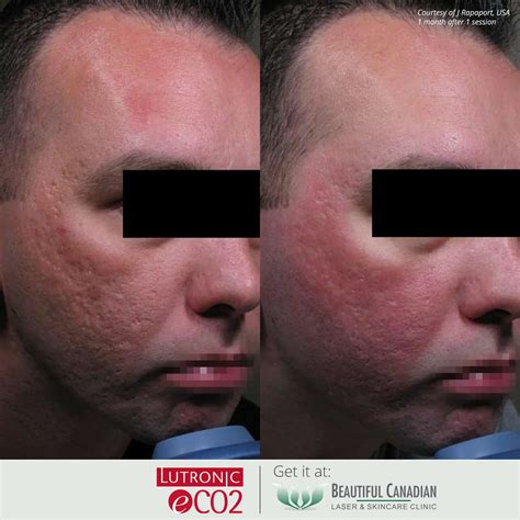 Vancouver Fractional CO2 Laser Skin Resurfacing Surrey Delta Langley