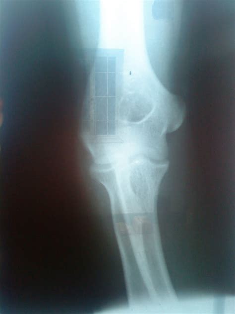 Gruporx4 Codo Proyeccion Anteroposterior Flexion Parcial