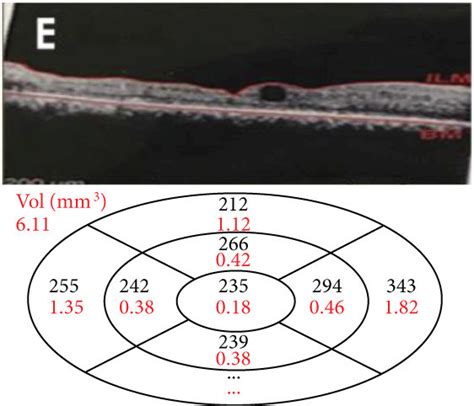 A Right Eye Preoperative Red Free Color Coded Map Showing Marked Dme Download Scientific