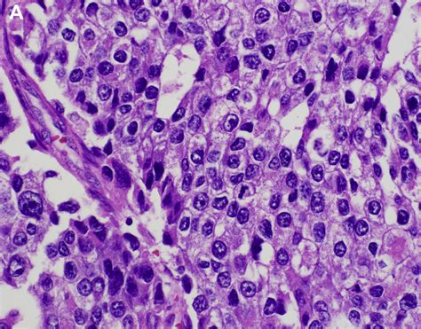 Pulmonary Neuroendocrine Tumors Surgical Pathology Clinics