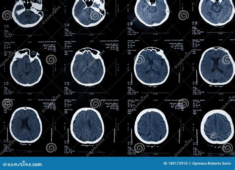 Images From A Computerized Tomography Of The Brain Stock Photo Image