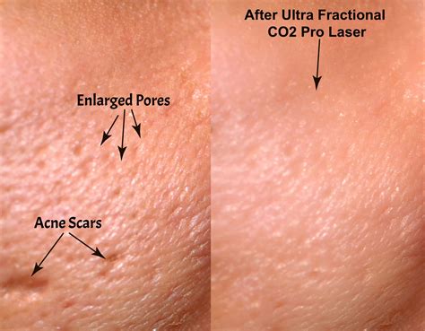 Ultra Fractional CO2 Pro Laser