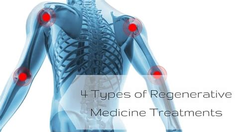 4 Types Of Regenerative Medicine Treatments Prolotherapy Platelet Rich Plasma Therapy And