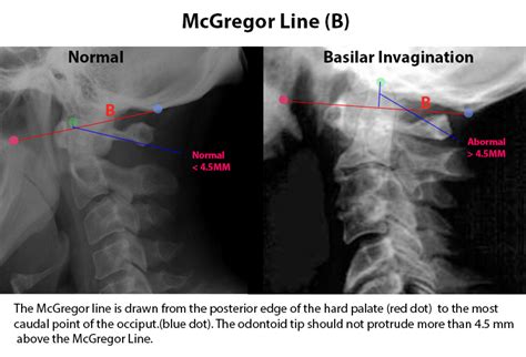 Arthritis Cervical Spine Mri