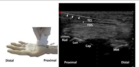 Figure 1 From Ultrasound Guided Percutaneous Release Procedures In The Transverse Carpal