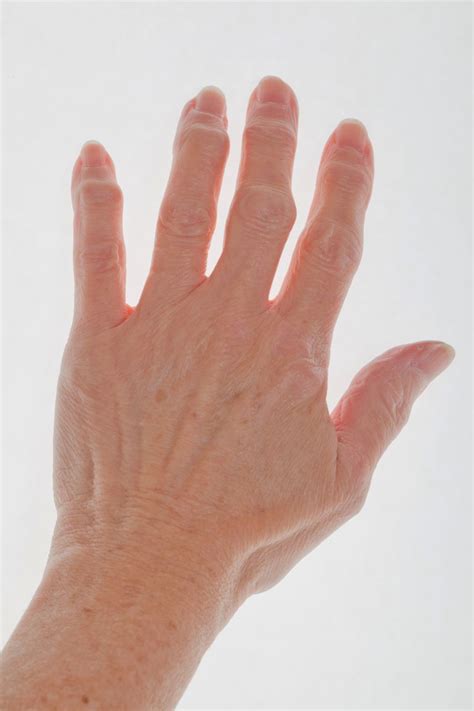 Finger Arthritis: Signs, Symptoms, and Treatment