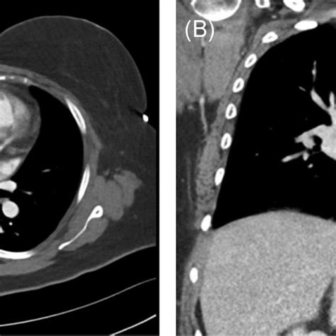 Initial Presentation Cta Presuming Massive Saddle Embolus Top Panel Download Scientific