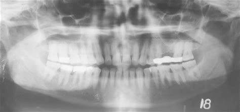 Orthopantomograph Of The Same Patient With No Pathological Finding With