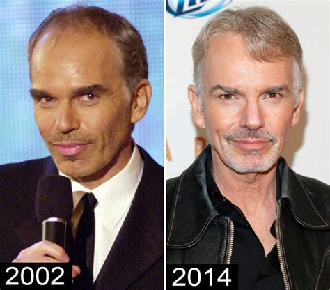 Bald Hollywood 5 Actors That Have Had Hair Transplants Chicago Hair