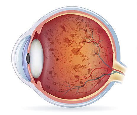 Retinosis pigmentaria Consulta de Oftalmología Pediátrica Dr