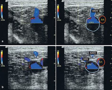 Examination of the Great Saphenous Vein | Radiology Key