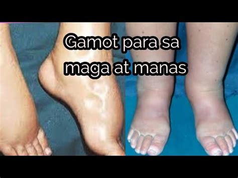 Gamot Sa Pamamaga Ng Paa Medisinagamot