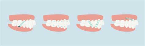 Biomechanics of Clear Aligners (Analysis of Acting Forces)