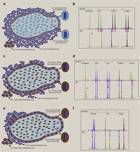 Hydatidiform Moles Differential Diagnosis Diagnostic Reproducibility