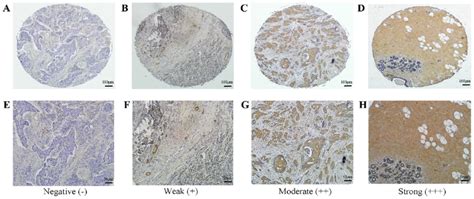 Immunohistochemical Staining Of BCSC 1 In Tissue Microarrays Tissue