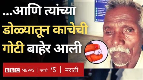 या आजोबांच्या डोळ्यातून ऑपरेशननंतर चक्क एक गोटी बाहेर आली Bbc News मराठी