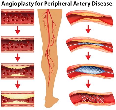 Diagrama de angioplastia para doença arterial periférica Vetor Premium