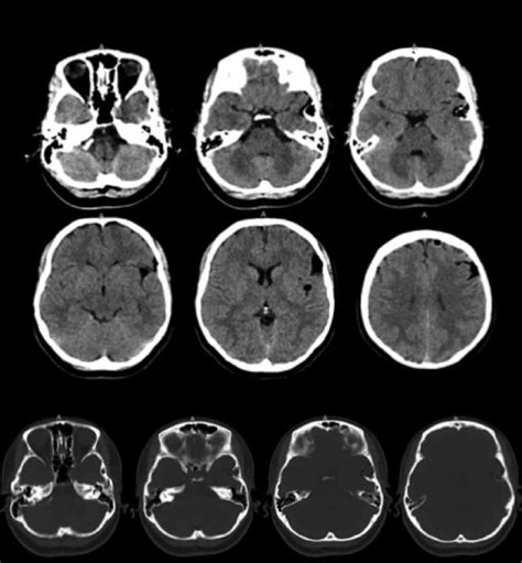 Tomografia Axial Computarizada De Craneo Simple