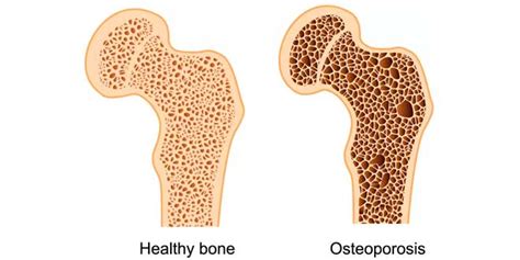 Calcium Vitamine D et Densité Minérale Osseuse Blog HSN