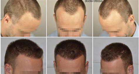 Hair Transplant In Turkey