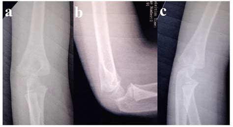 Six Months Follow Up Radiographs Showed Healed Fracture And Reduced