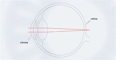 Hipermetropía Causas Diagnóstico Y Tratamiento Icr