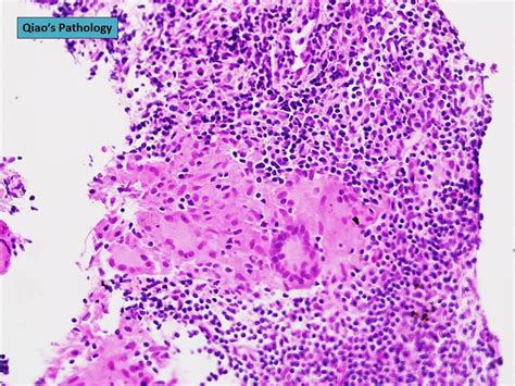 Qiao S Pathology Sarcoidosis Of Axillary Lymph Nodes Flickr