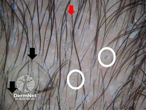 Trichoscopy Of Localised Noncicatricial Hair Loss — Dermnet