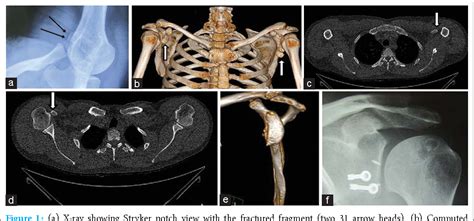 Figure 1 From Bilateral Coracoid Avulsion Fractures With Unilateral