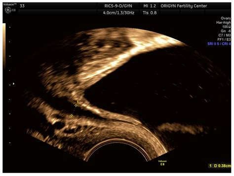 Diagnostics Free Full Text Transvaginal Ultrasound As A First Line