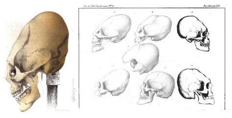 Elongated Skulls In Utero A Farewell To The Artificial Cranial