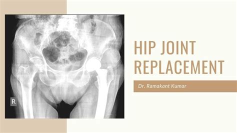 Hip Joint Replacement - Types, Complications & Surgery