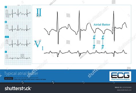 Male Years Old Clinically Diagnosed Stock Illustration