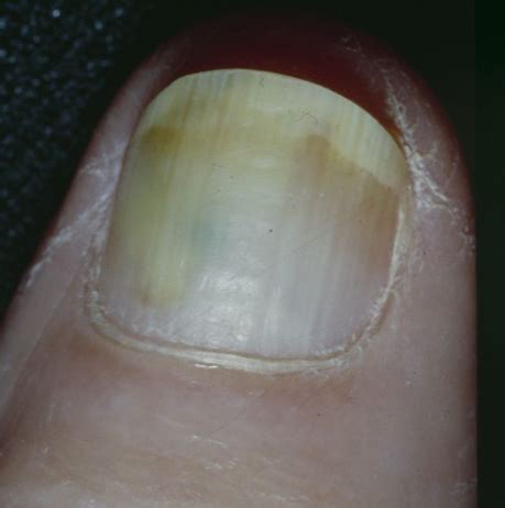 Pseudomonas Aeruginosa Nail Infection - Nail Ftempo