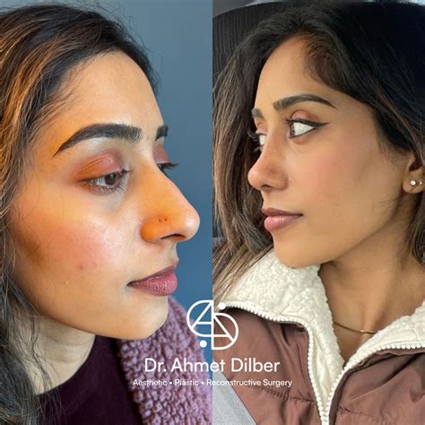 Rhinoplasty Result Dr Ahmet Dilber Nose Plastic Surgery