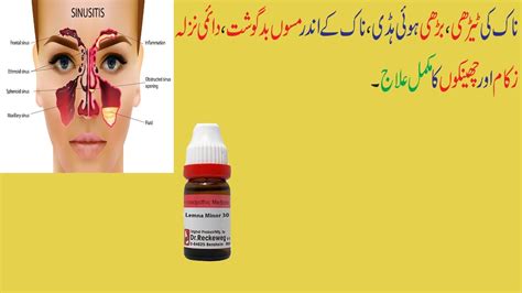 Lemna Minor 30 200 Treatment Of Sinusitis Treatment Of Nose Enlarged