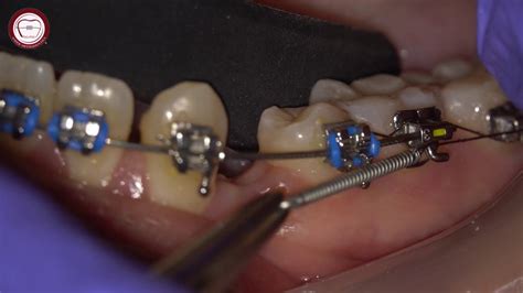 Closed Coil Spring In Orthodontic Canine Traction Asker Orthodontics