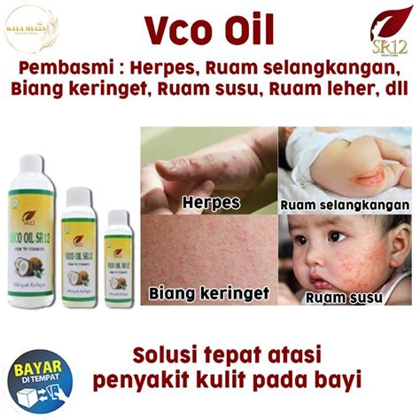 Jual Ampuh Obat Ruam Kulit Bayiruam Popok Bayivico Oil Sr12