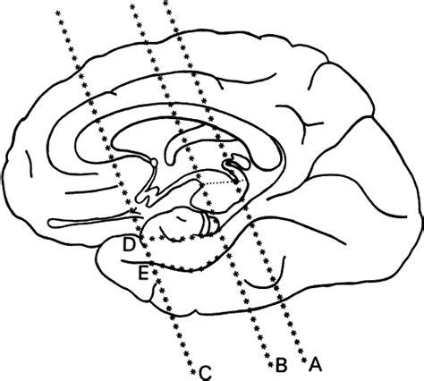 MRI Protocols: Temporal lobe MRI Reference lines