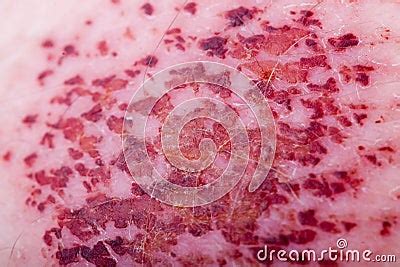 Bruised Skin Texture Royalty Free Stock Photos - Image: 3145948