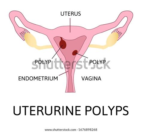 Uterine Polyps Human Uterus Anatomy Illustration Stock Vector Royalty