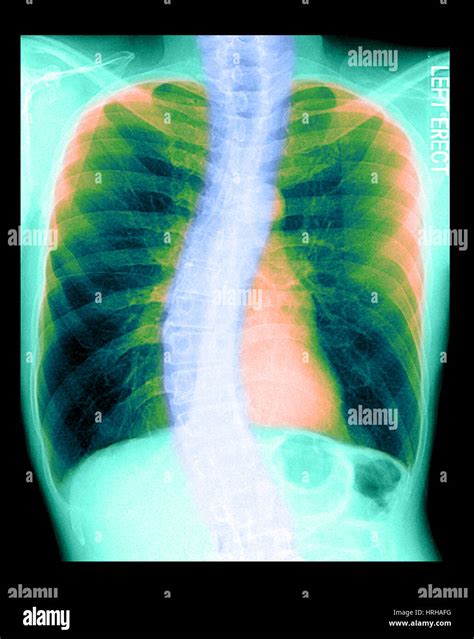 Radiographie D Une Scoliose Thoracique Banque De Photographies Et D