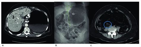 Contrast enhanced CT scan performed upon admission (a) axial image ...